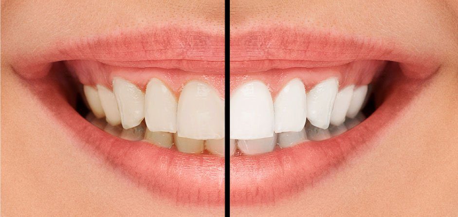 Read more on 5 Common Myths About Teeth Whitening