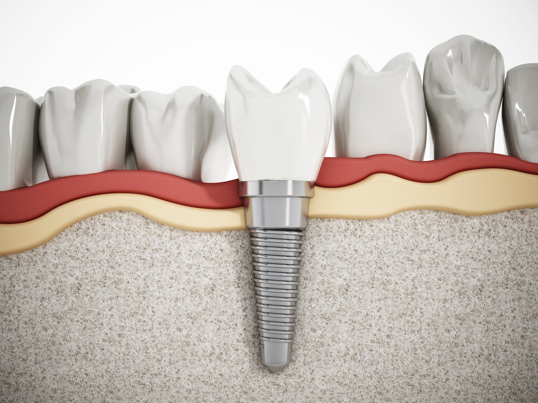 how-to-know-if-you-need-dental-implants-west-kelowna-restore